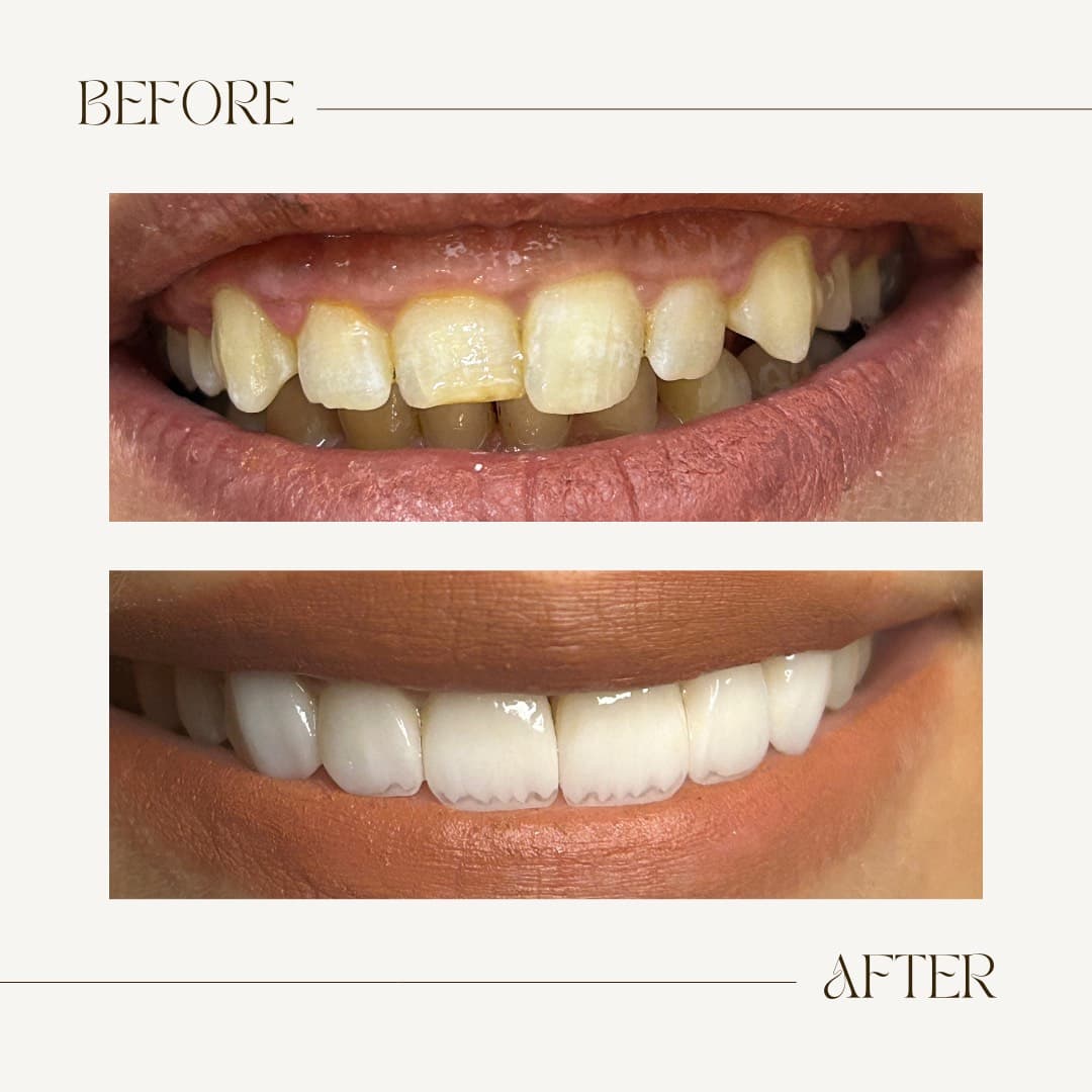 Emax Veneers Smile Makeover