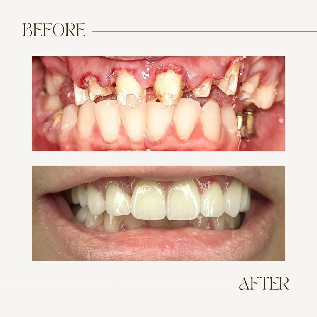Full-Mouth Dental Implant Restoration