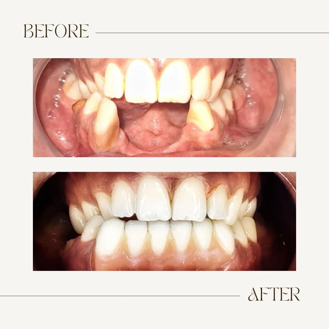 Gummy Smile Correction & Implant