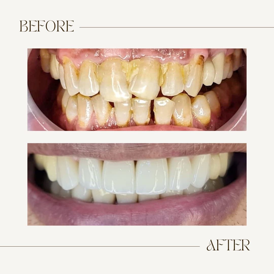 Braces & Whitening with Zircon Crowns